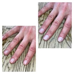 Ibx treatments Nail repair