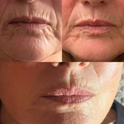 High frequency facial