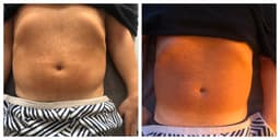 Brazilian Manual Lymphatic Drainage Massage