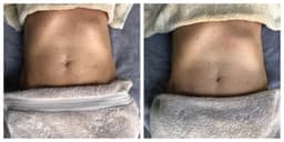 Brazilian Manual Lymphatic Drainage Massage