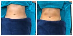 Brazilian Manual Lymphatic Drainage Massage