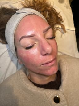 Post microneedling glow
