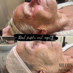Million Dollar Facial