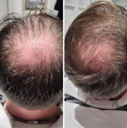Anti hair loss microneedling