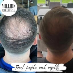 Anti hair loss microneedling