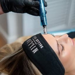 Million Dollar Microneedling