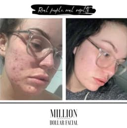 Million Dollar Facial