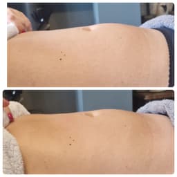 Lymphatic drainage results to help deal with bloating