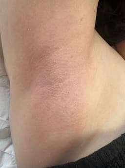 Minimal irritation is caused when using Hot wax instead of strip wax