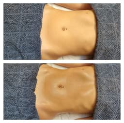 Brazilian drainage Instant before/after