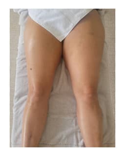 Brazilian drainage Instant before/after