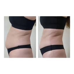 Brazilian drainage Instant before/after