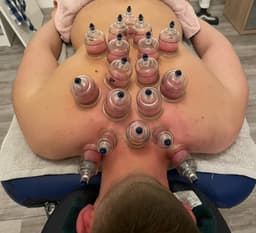 Myofascial dry cupping treatment