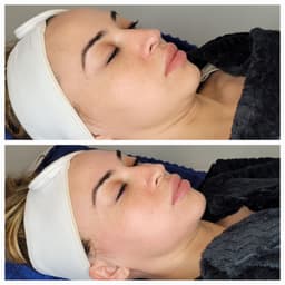 Million Dollar Hydrate Superficial Peel