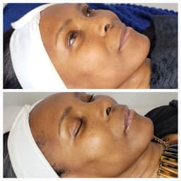 Million Dollar Glow Superficial Peel