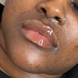 1ml lip filler