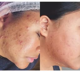 Bioactive algae peel