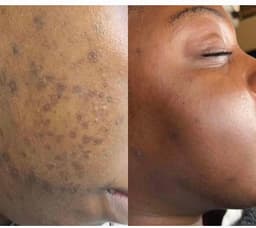 Bioactive algae peel