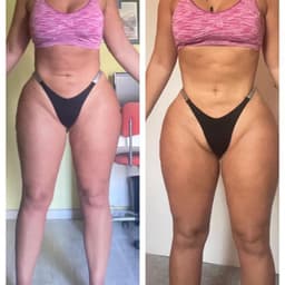 Radio frequency plus lymphatic drainage