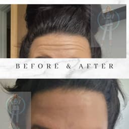 Botox