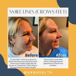 Smile line before and after