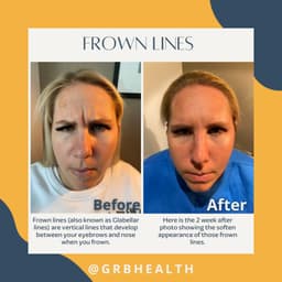 Frown lines - before and after