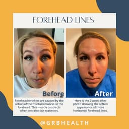 Forehead lines - before and after