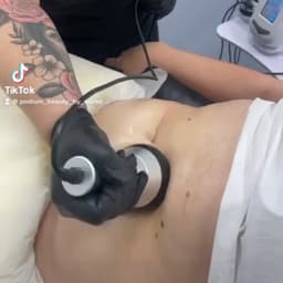 Fat cavitation