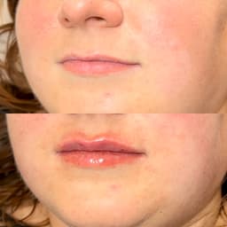 Lip augmentation