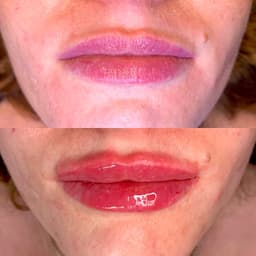 Lip augmentation