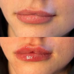 Lip augmentation