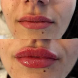 Lip augmentation