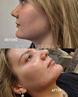 1 session lemon bottle jaw & neck