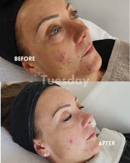 Before & after skin improvements with regular facials