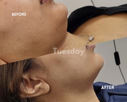 B&A chin lemon bottle. 1st treatment