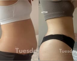 B&A lower tummy lemon bottle. First session 12 days difference.