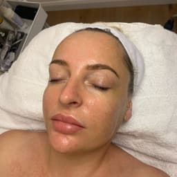 Post PureHydrate HydroFacial Glow