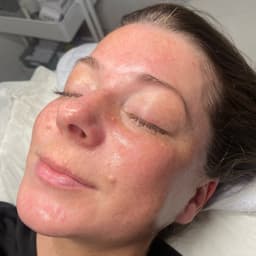 Post Hydrofacial glow leaving the skin brighter & hydrated