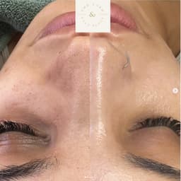 Results after a derma-luxe treatment