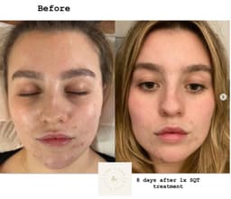 SQT Resurfacing