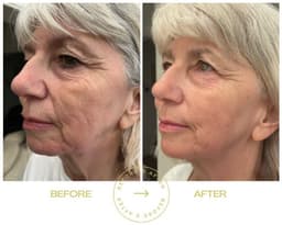 Results after 3x SQT Anti- Age