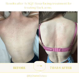 Sqt bio- microneedling