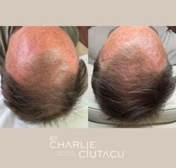 Hair Restoration treatment