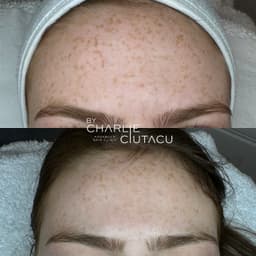 Results from liquid micro-needling