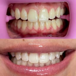 60 minute Teeth Whitening