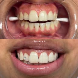 60 minute Teeth Whitening