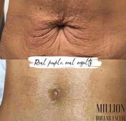 Million Dollar Body Treatment