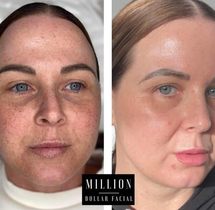 Million Dollar Peels