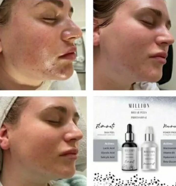 Million Dollar Eliminate Peel