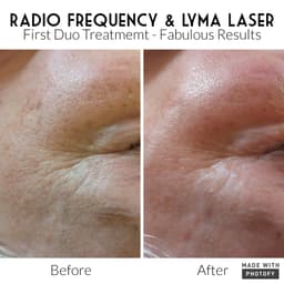 Lyma Laser Pro & Radio Frequency, cellular Transformation Facial